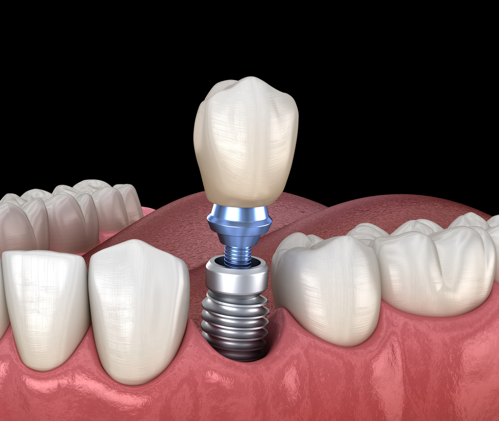 Implantes de dentes para idosos: como funcionam? 4 Implantes de dentes para idosos