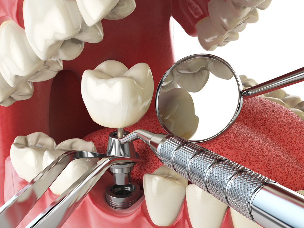 Implantes de dentes para idosos: como funcionam? 3 implante